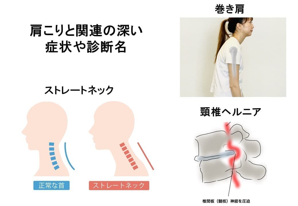 肩こりと関連の深い症状と診断名