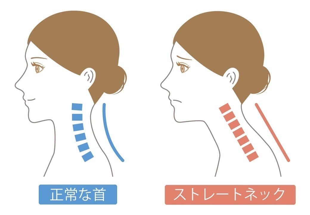 ストレートネック