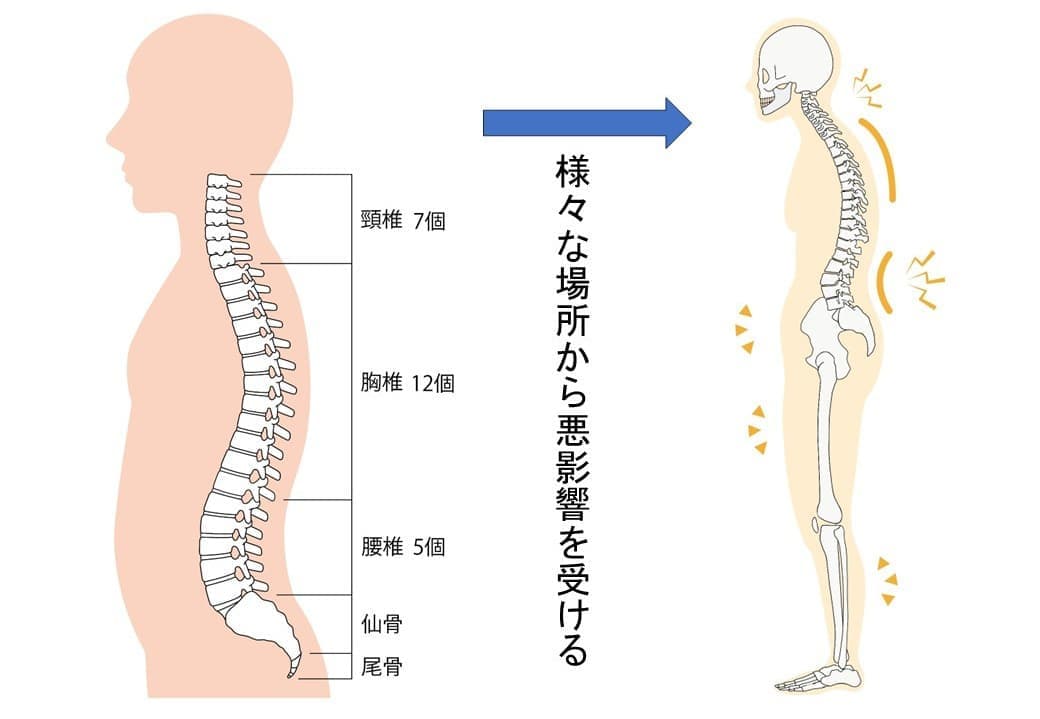 ストレートネックの悪影響